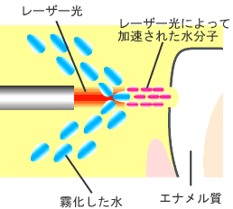 レザー治療の図解
